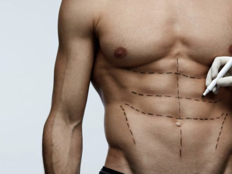 Six Pack (Erkek Karın Estetiği)
