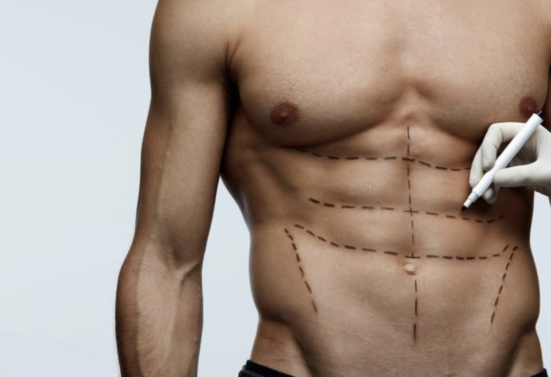 Six Pack (Erkek Karın Estetiği)