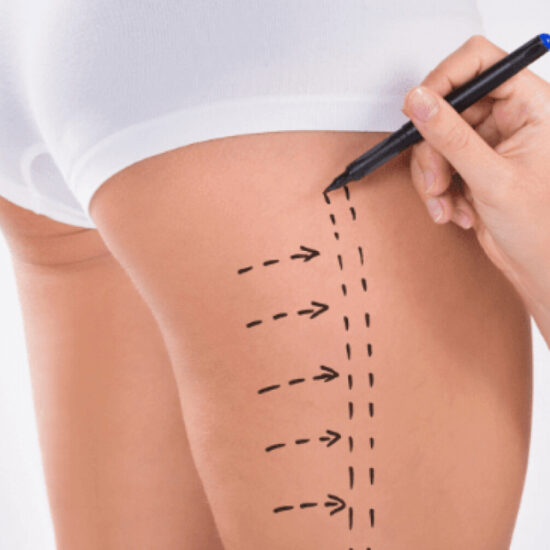 Uyluk Liposuction