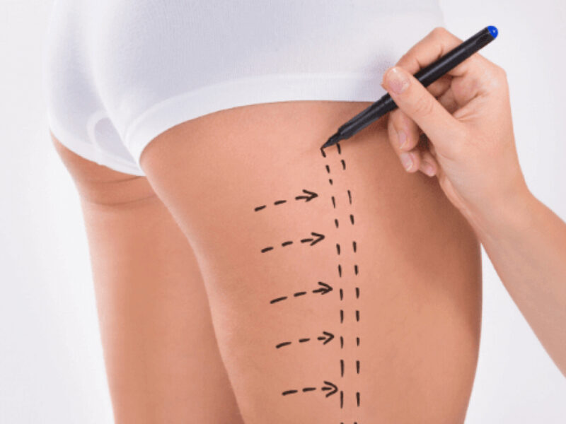 Uyluk Liposuction