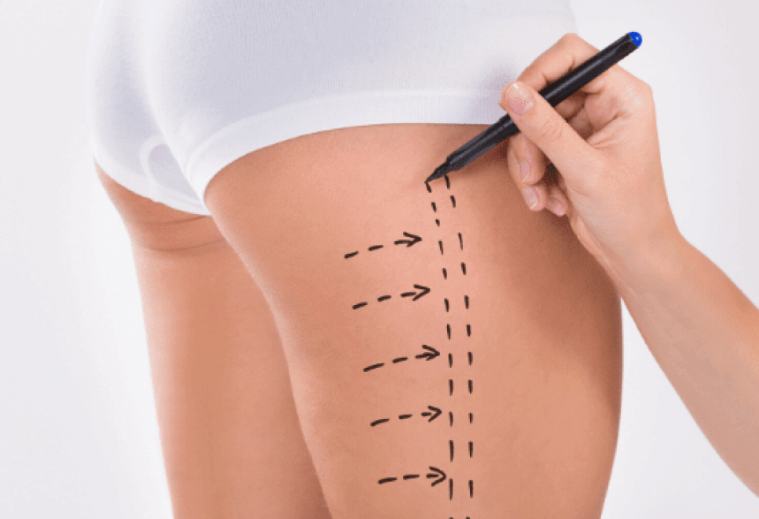 Uyluk Liposuction